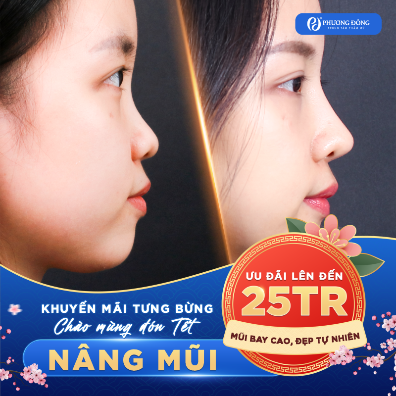 Nâng mũi thẩm mỹ