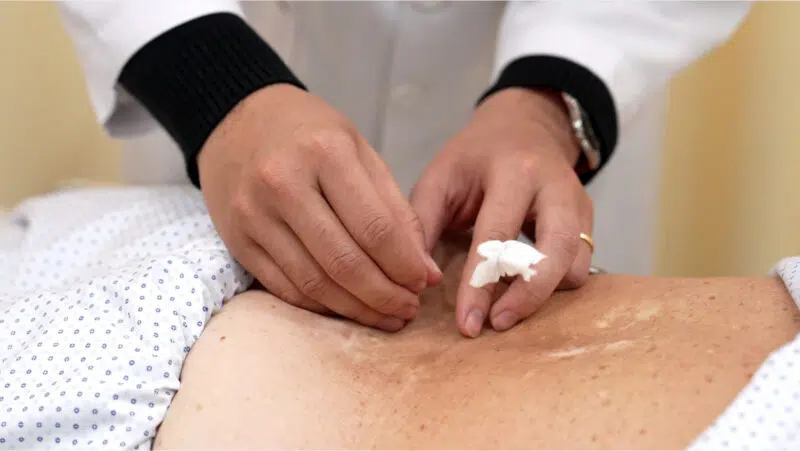 Điện mãng châm điều trị hội chứng thắt lưng- hông