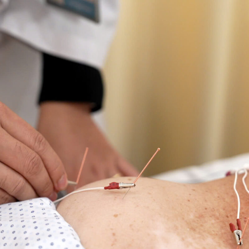 Điện mãng châm điều trị hội chứng thắt lưng- hông