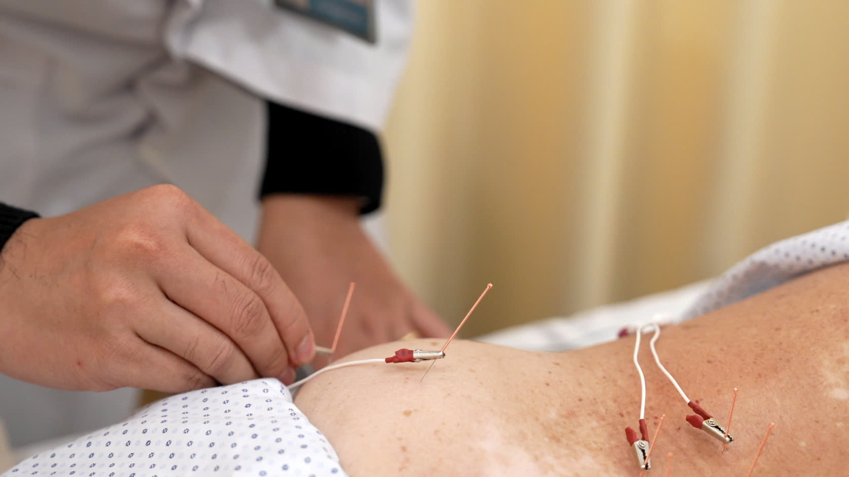 Điện mãng châm điều trị hội chứng thắt lưng- hông