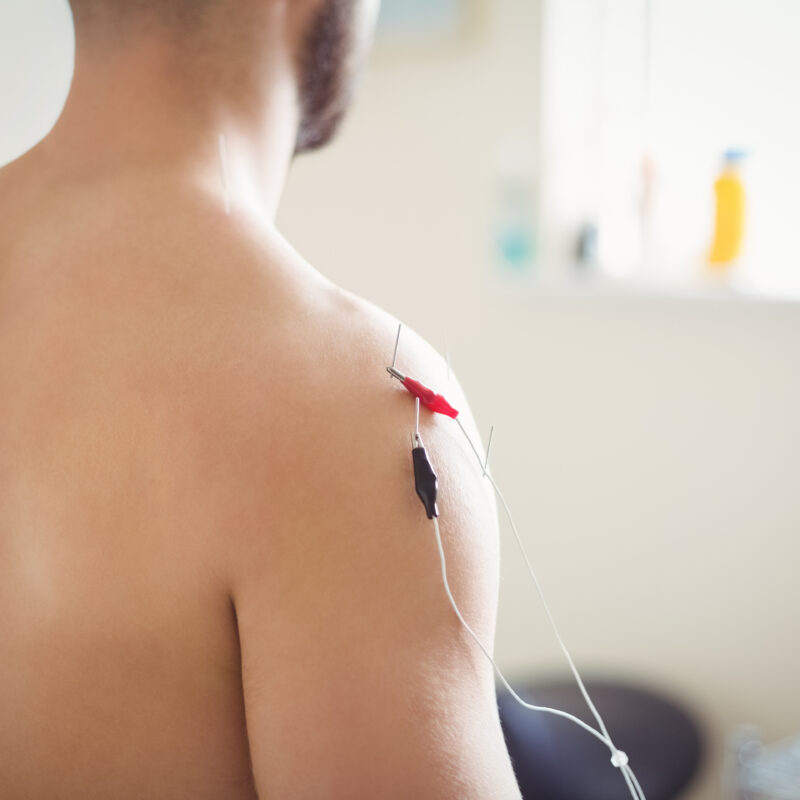 Điện mãng châm điều trị hội chứng vai gáy