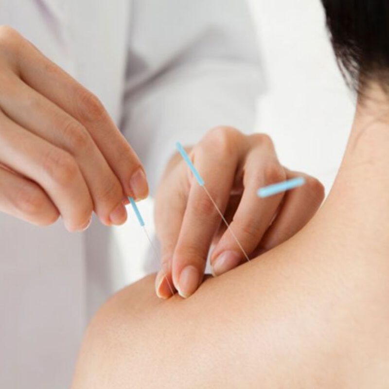 Điện mãng châm điều trị liệt chi trên