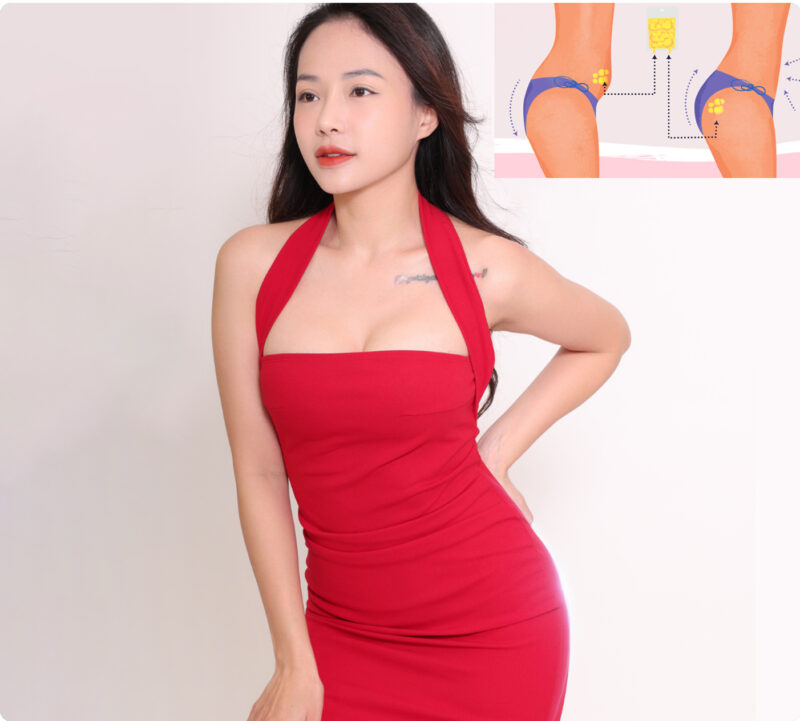 DEAL GIÁ TỐT - Cấy mỡ nâng mông tự thân (*)