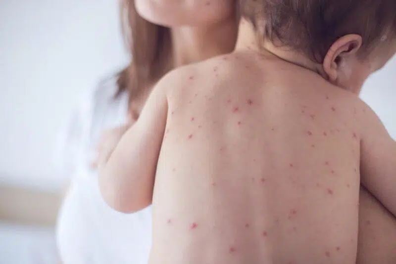Gói thuốc Thúc ban giải nhiệt - Hình ảnh 2