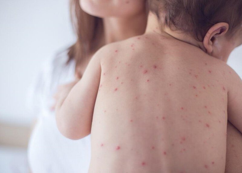 Gói thuốc Thúc ban giải nhiệt