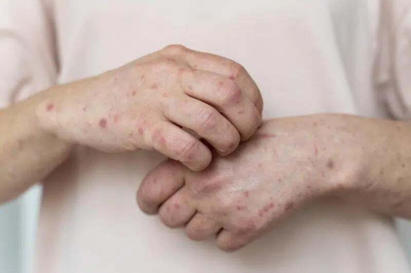 Gói thuốc Thúc ban giải nhiệt - Hình ảnh 4
