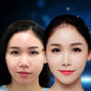 CẤY MỠ MÁ