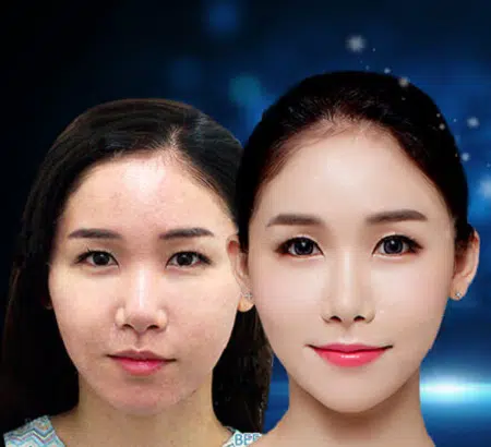 CẤY MỠ MÁ