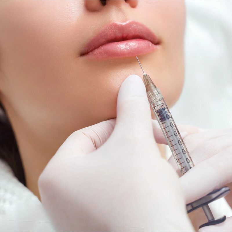 deal 1499k tiêm filler