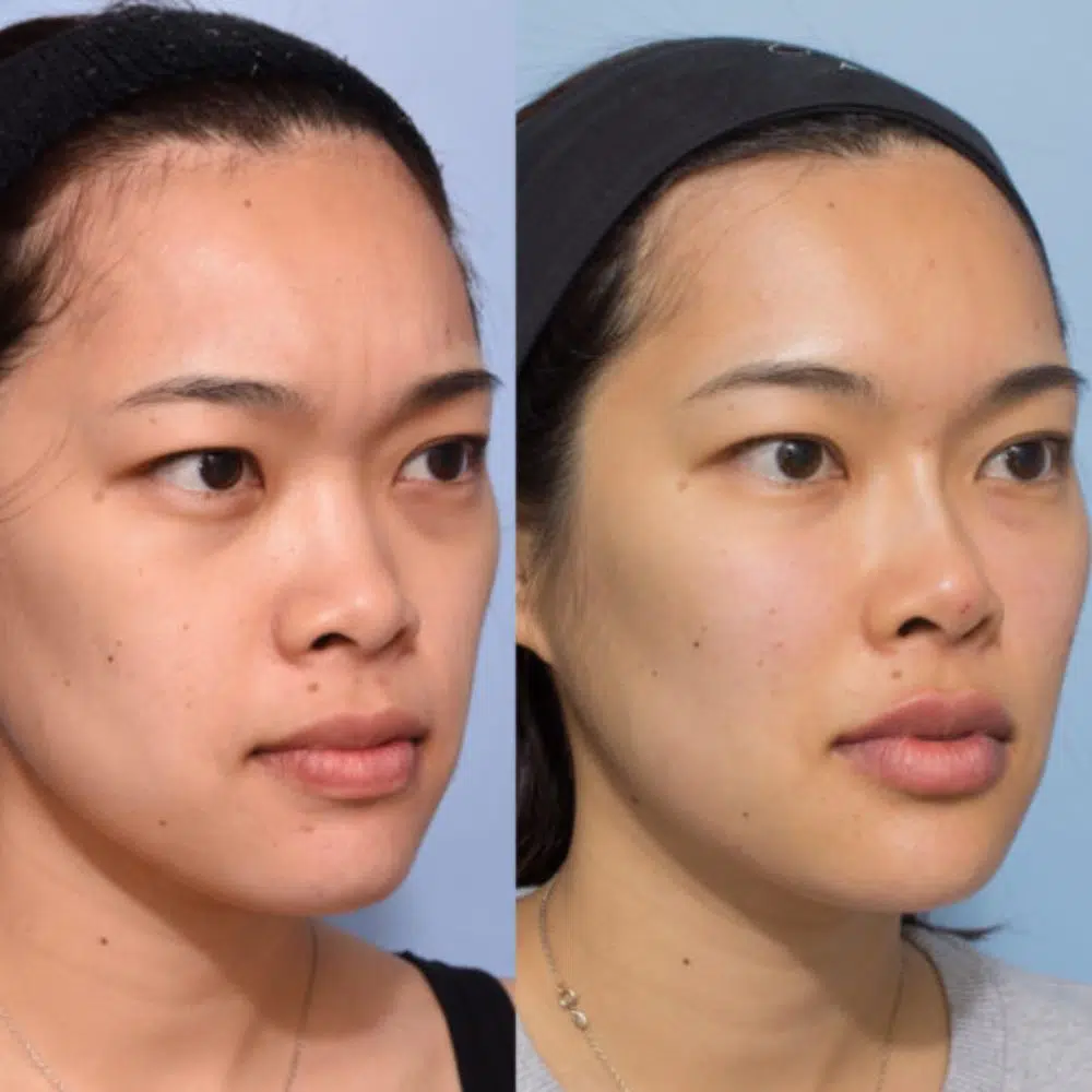 DEAL 1.499K| Tiêm Filler VOL 2 Định hình và Trẻ hoá gương mặt (định lượng 1cc) - Hình ảnh 2