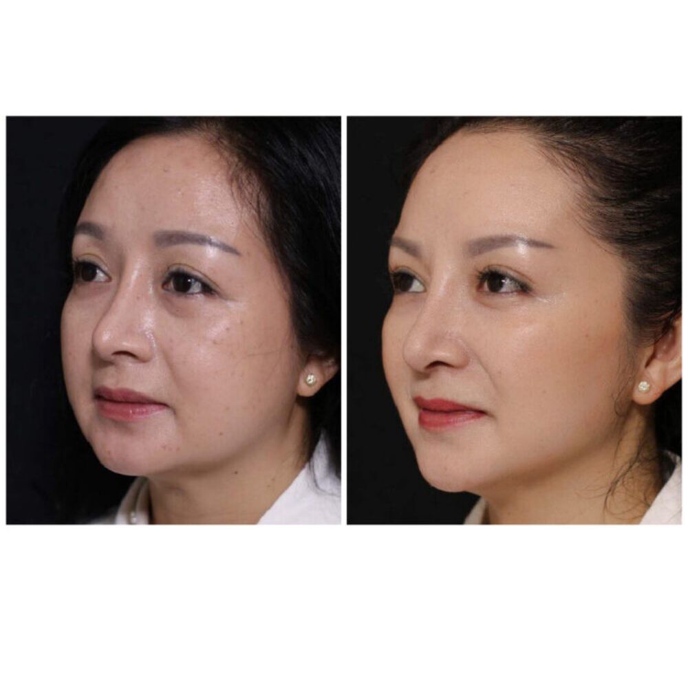 DEAL 1.499K| Tiêm Filler VOL 2 Định hình và Trẻ hoá gương mặt (định lượng 1cc) - Hình ảnh 3