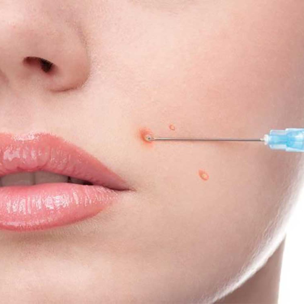 deal 1299k tiêm tế bào gốc trị mụn