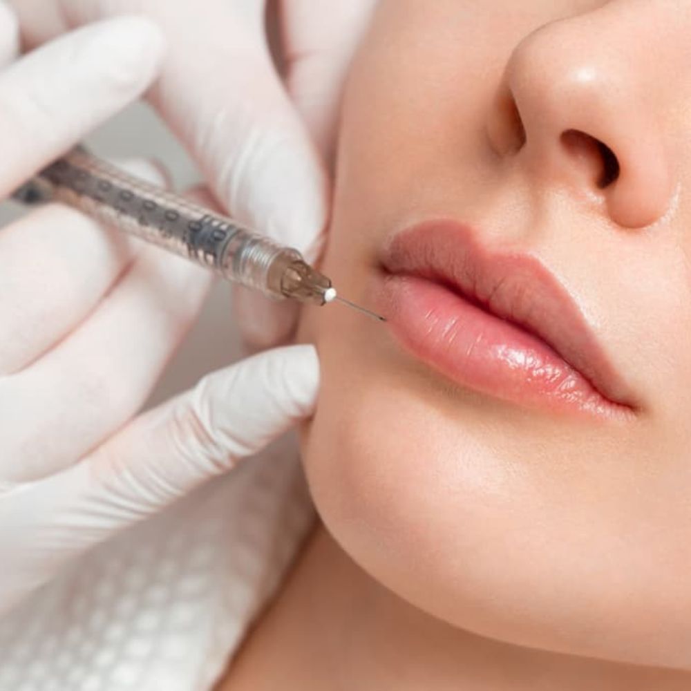 deal1499k tiêm filler vol3