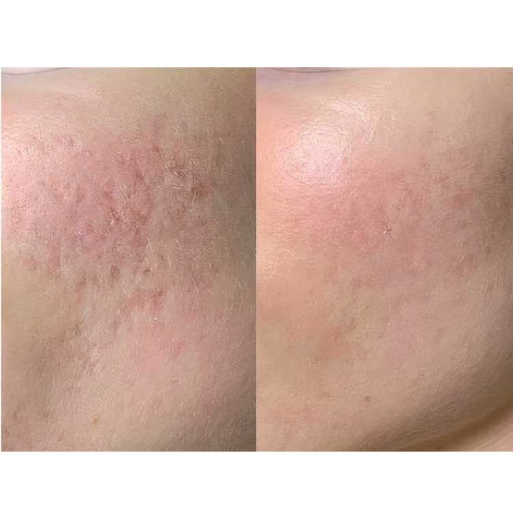 DEAL 1.299K| Tiêm Tế bào gốc trị mụn (định lượng 01 lọ) - Hình ảnh 2