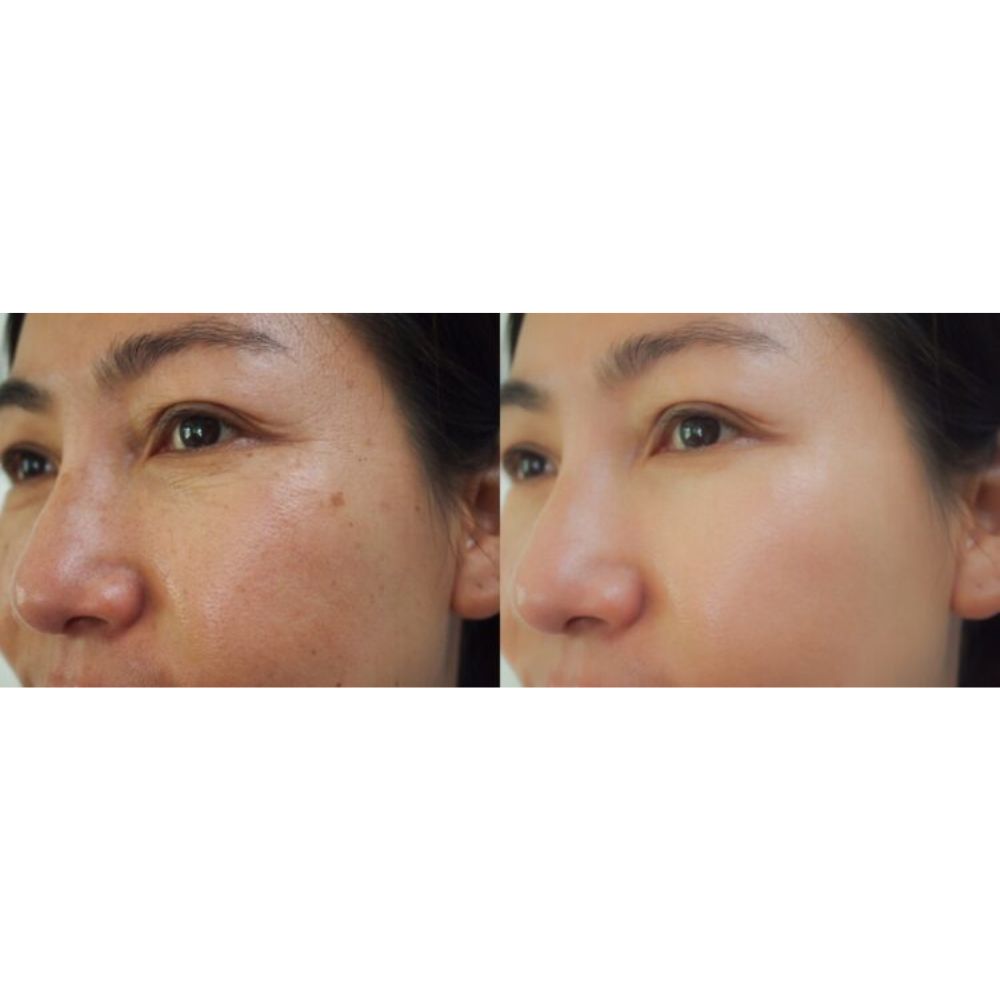 DEAL 1.299K| Tiêm Tế bào gốc trị mụn (định lượng 01 lọ) - Hình ảnh 3