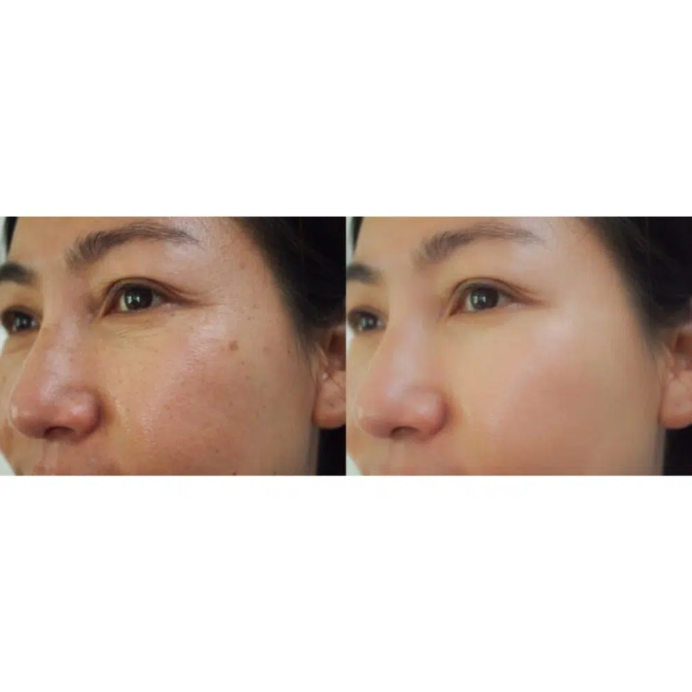 DEAL 1.299K| Tiêm Tế bào gốc trị mụn (định lượng 01 lọ) - Hình ảnh 3