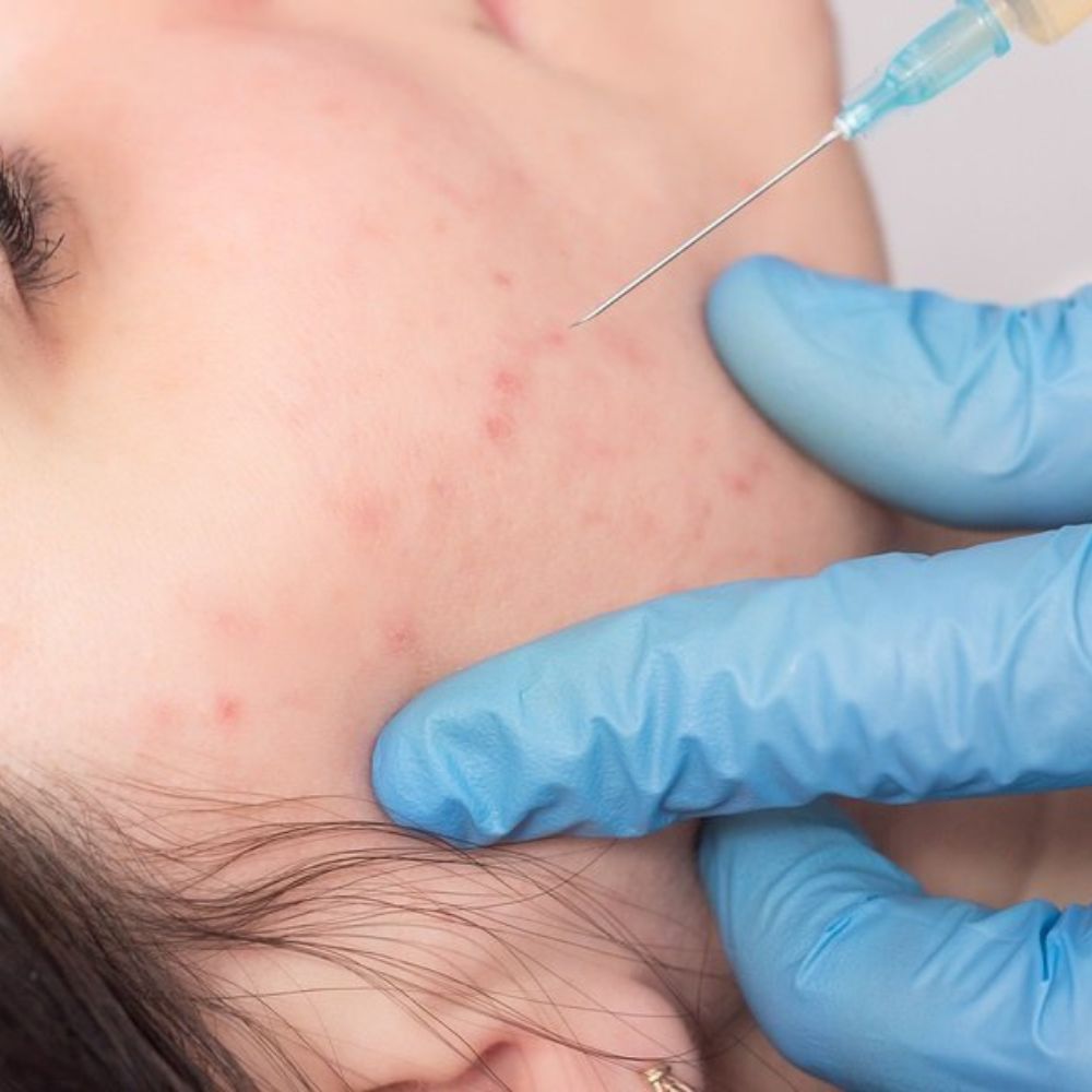 DEAL 1.299K| Tiêm Tế bào gốc trị mụn (định lượng 01 lọ) - Hình ảnh 4