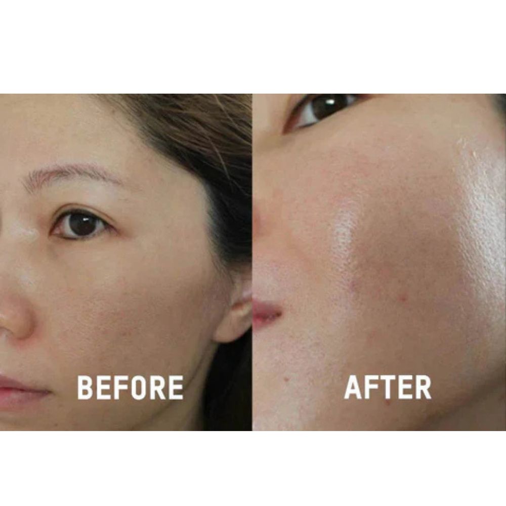 DEAL 1.299K| Tiêm HA Trẻ hoá làn da (định lượng 1 lọ) - Hình ảnh 2