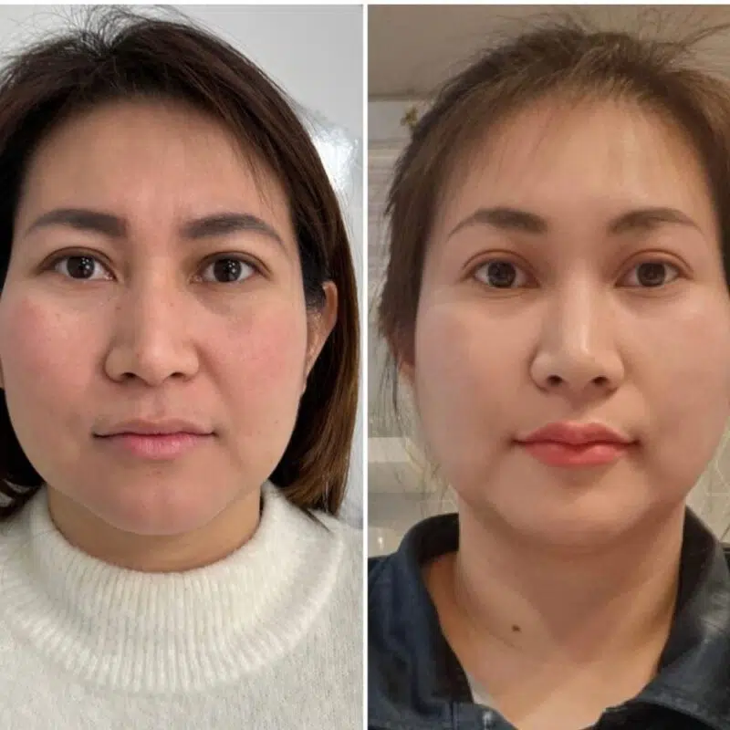 deal1499k tiêm filler vol3