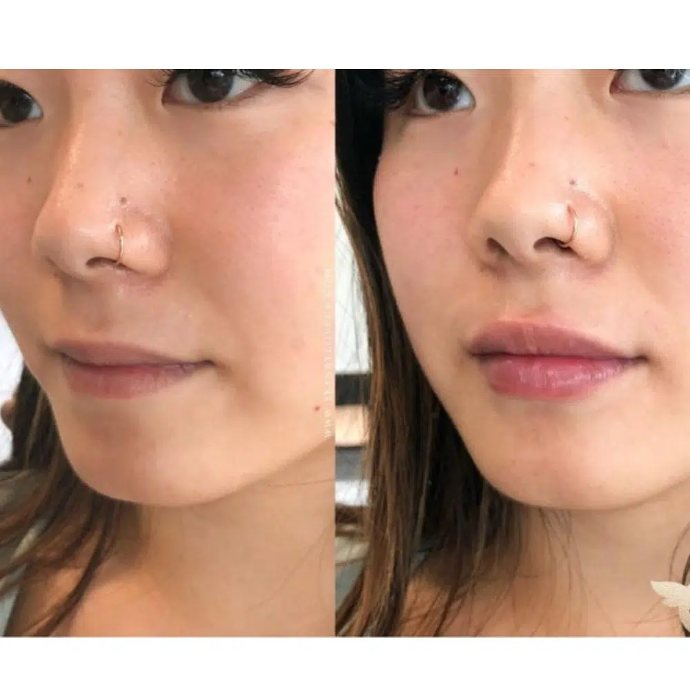 DEAL 1.499K| Tiêm Filler VOL 3  Nâng tầm diện mạo (định lượng 1cc) - Hình ảnh 3