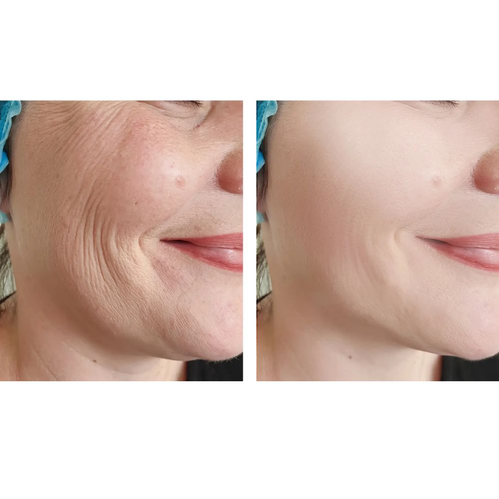 DEAL 1.499K| Tiêm Filler VOL 3  Nâng tầm diện mạo (định lượng 1cc) - Hình ảnh 2