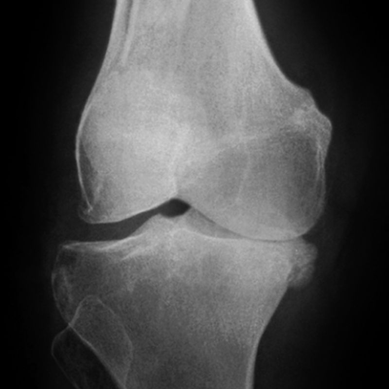 chụp xquang 1 khớp