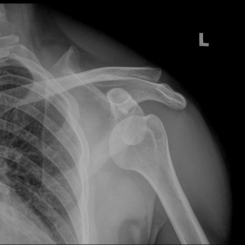 chụp xquang 1 khớp