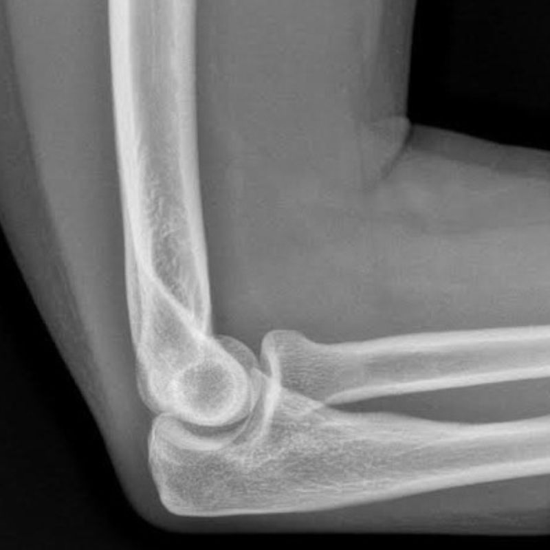 chụp xquang 1 khớp