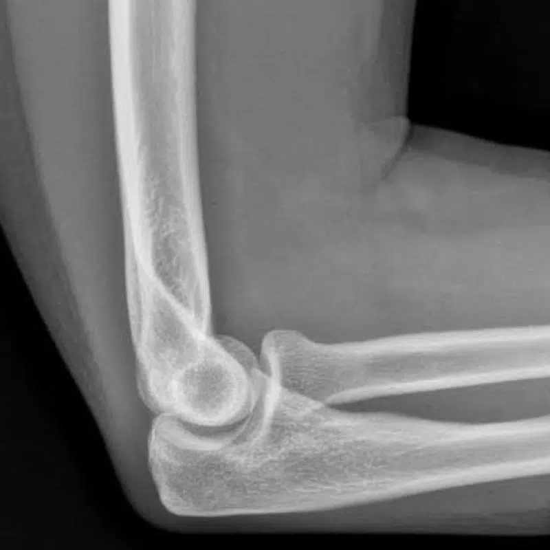 chụp xquang 1 khớp