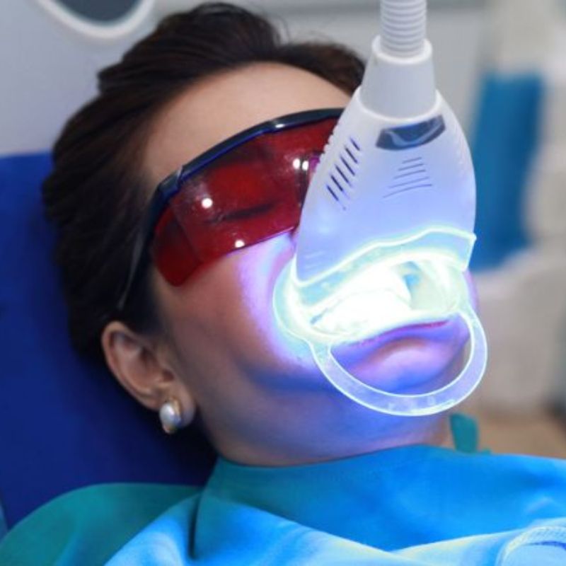 Tẩy trắng răng tuỷ sống có sử dụng đèn flash